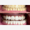 Teeth Whitening at Elite Dental Studios (63787)