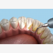 Teeth Whitening at Elite Dental Studios (63790)