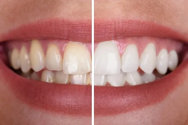 Braces, Dentist in Polokwane at HopeWell Med photo 4