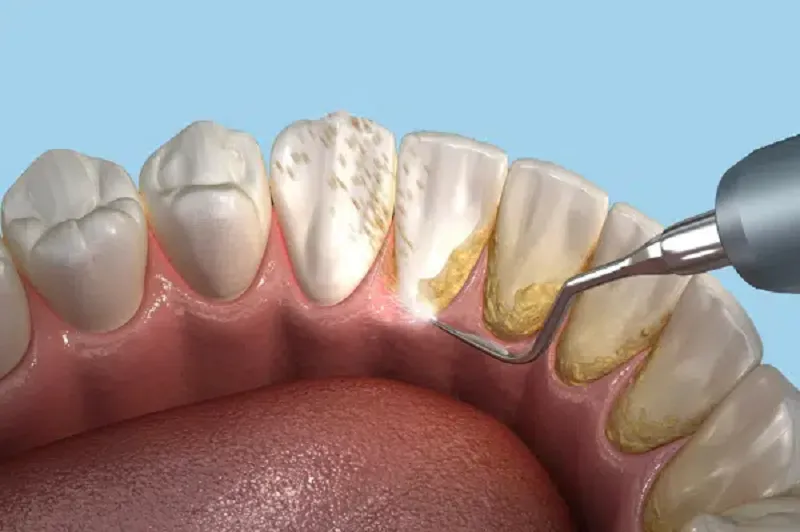 Teeth Whitening at Elite Dental Studios photo 1
