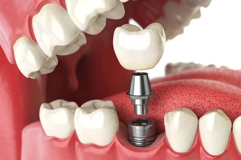 Teeth Whitening at Elite Dental Studios photo 2