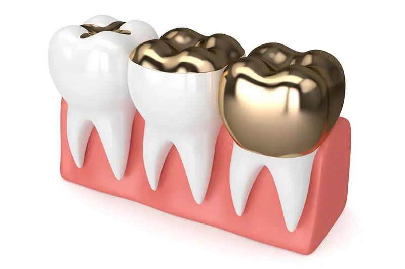 Teeth Whitening at Elite Dental Studios photo 3